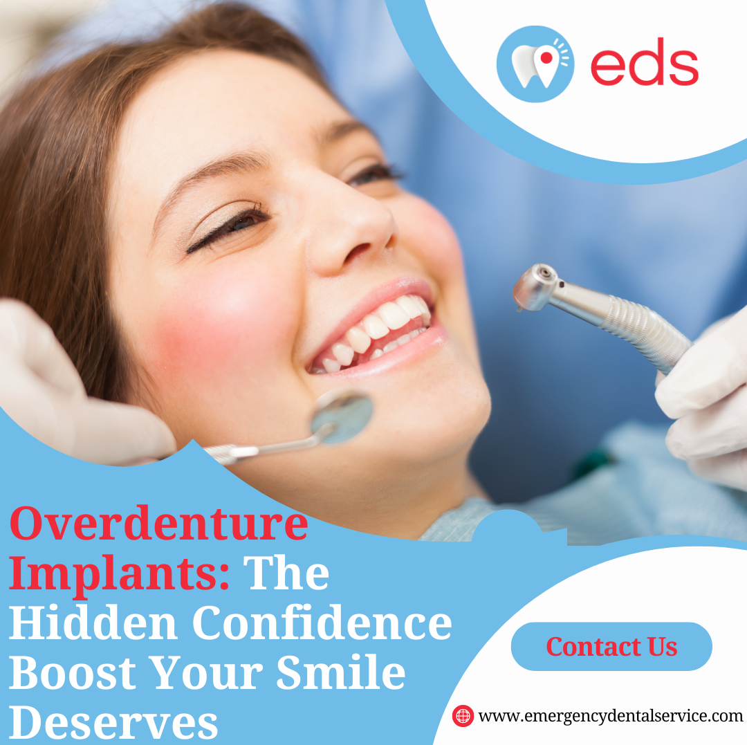 Overdenture Implants
