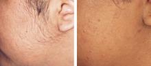 Electrolysis Hair Removal in Dubai