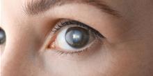Cataracts can develop in different forms, and each type affects vision in its own way. From blurriness and glare to difficulty seeing at night, knowing the type of cataract is key to getting the right treatment. In this post, the Best Eye Surgeon & Ophthalmologist in Vaishali explains the main types of cataracts and how they impact your eyesight, helping you make informed decisions for clearer, healthier vision.