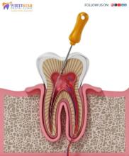 Root canal treatmen