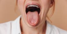 close up of a woman-showing dry tongue and braces