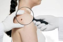 Mole removal in Dubai