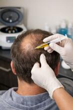 PRP Hair Restoration in Tomball