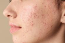 Blackheads Treatment in Ghaziabad
