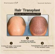 Best Hair Transplant in Ahmedabad