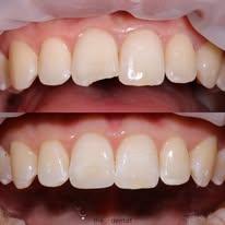 wisdom tooth extraction dentists