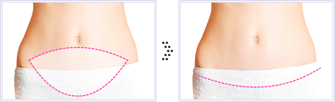 liposuction