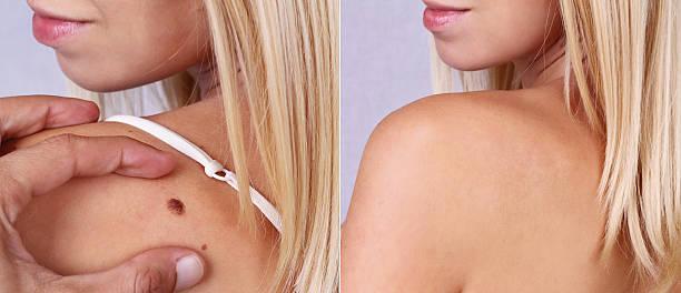 Laser wart removal in Dubai