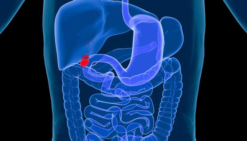 Best Doctors for Gallstones in kalyan