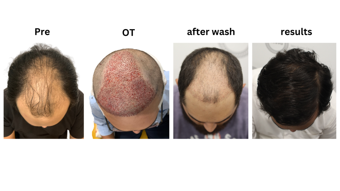 hair restoration clinics near me
