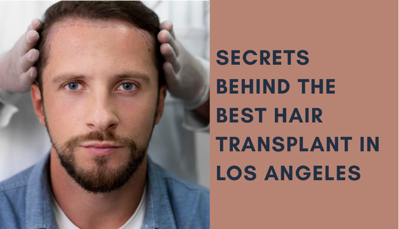 best hair transplant in Los Angeles