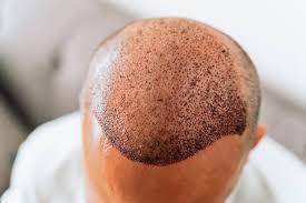 Hair Transplant Riyadh