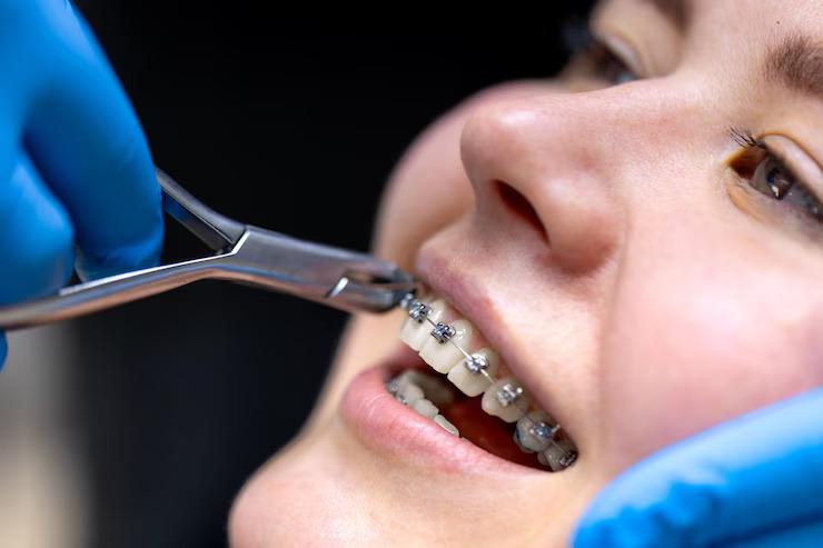 dental braces in Saskatoon