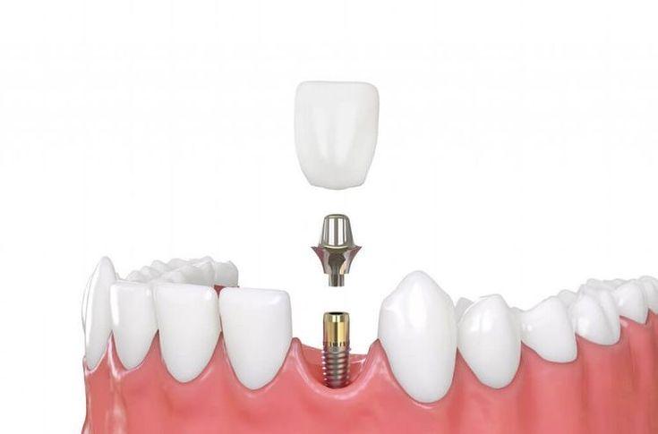 dental implant, dentist for implant, 