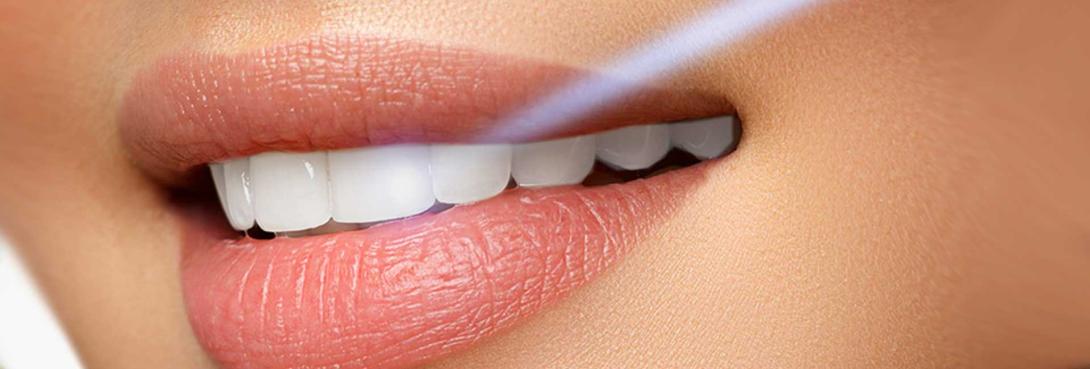 Teeth Whitening Lebanon, Dental clinic Lebanon