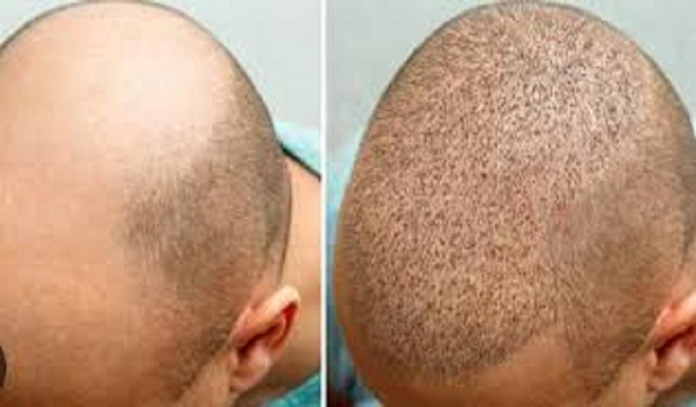 Hair Transplant Riyadh