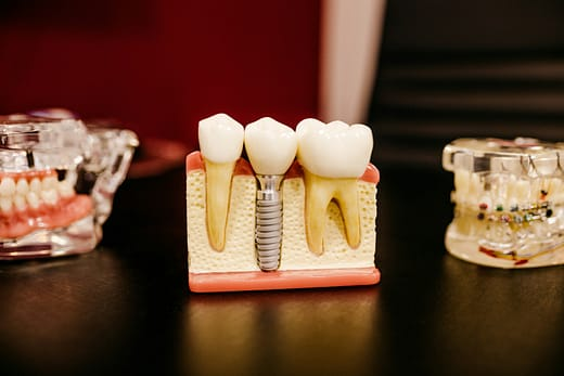 Dental implants in Oakville Ontario Canada