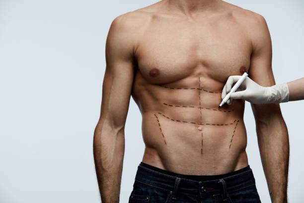 Liposuction in Dubai