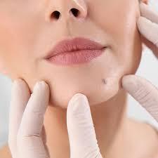 Mole Removal in Dubai