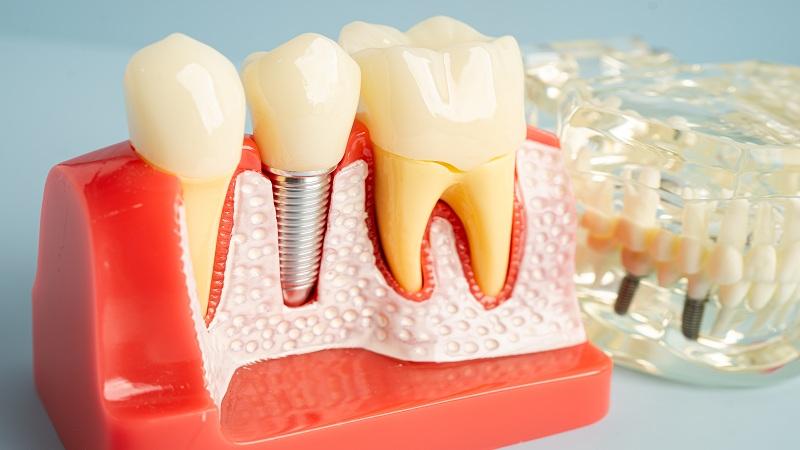 Immediate Implant Placement: