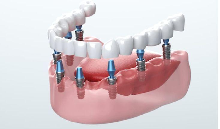 Teeth whitening Mississauga treatment at Revive Dental clinic