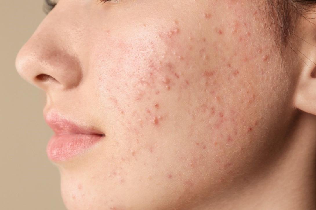 Blackheads Treatment in Ghaziabad