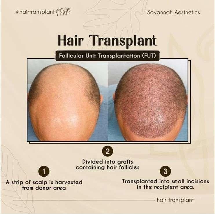 Best Hair Transplant in Ahmedabad