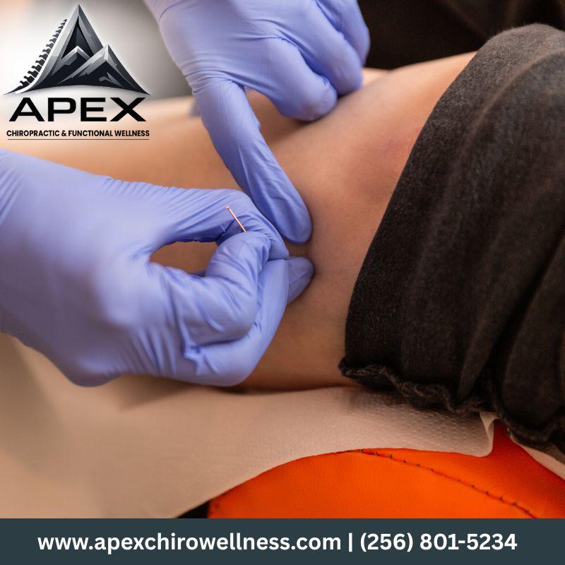 Dry Needling Downtown Huntsville